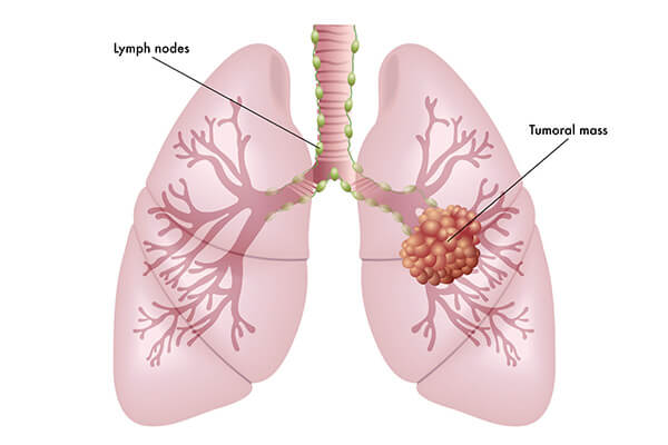 Lung Cancer Treatment In Malaysia