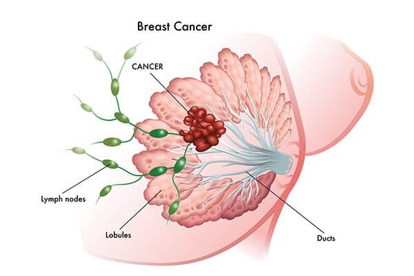 Breast Cancer Treatment In Malaysia