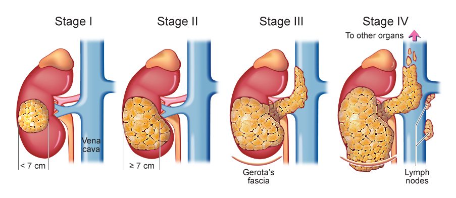 Kidney Cancer Treatment In Malaysia