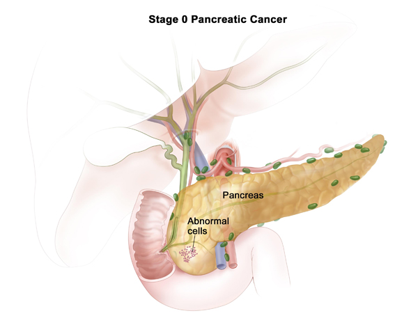 Pancreatic Cancer Treatment In Malaysia