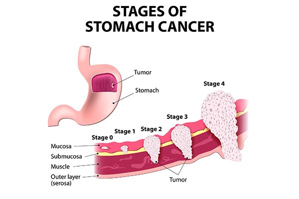 Stomach Cancer Treatment In Malaysia