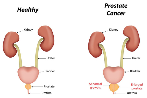 Prostate Cancer Treatment In Malaysia