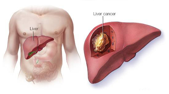 Liver Cancer Treatment In Malaysia
