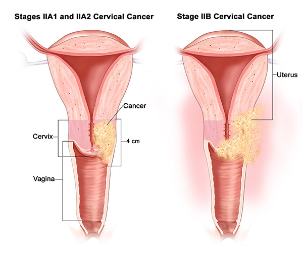 Cervical Cancer Treatment In Malaysia
