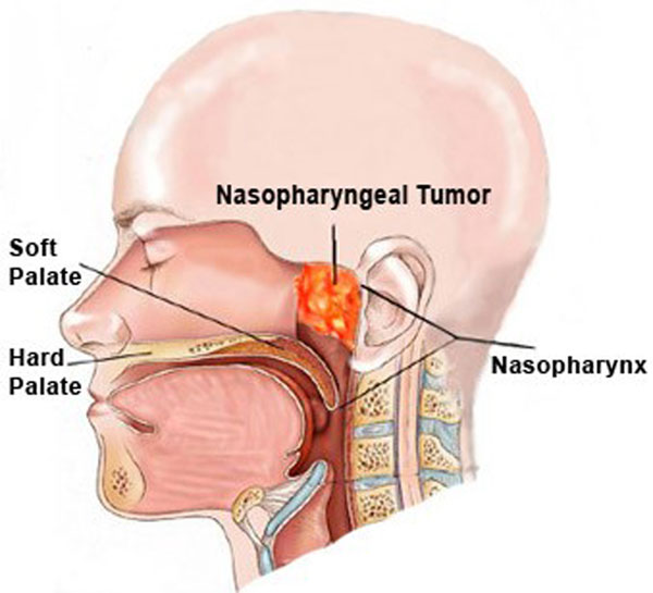 Nasopharyngeal Cancer Treatment In Malaysia