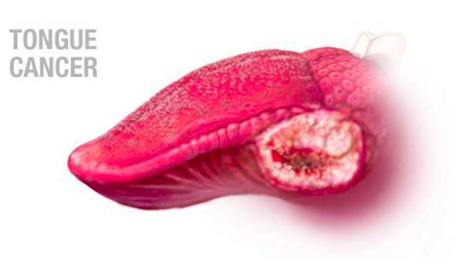 Tongue cancer treatment in malaysia