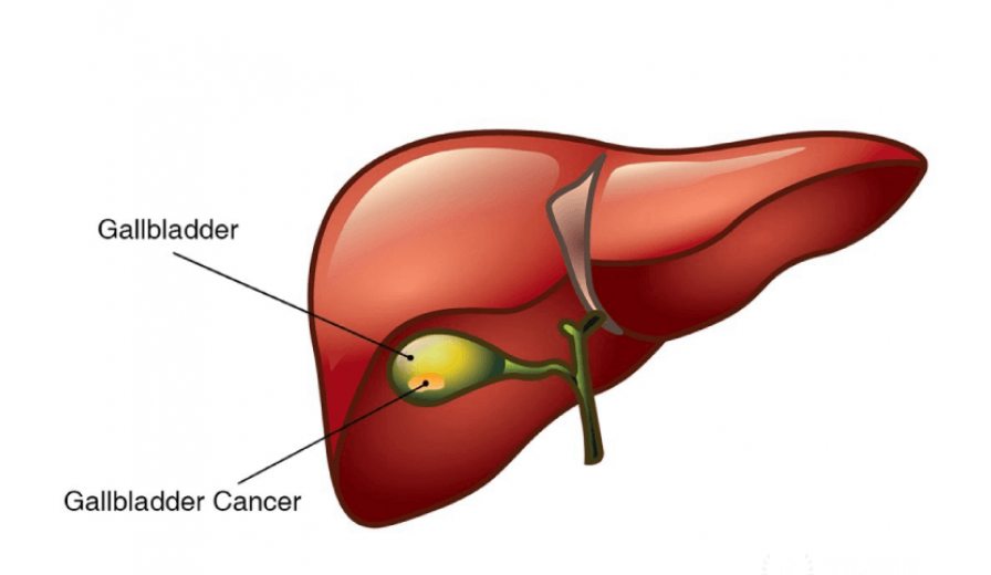 Gallbladder cancer treatment in Malaysia
