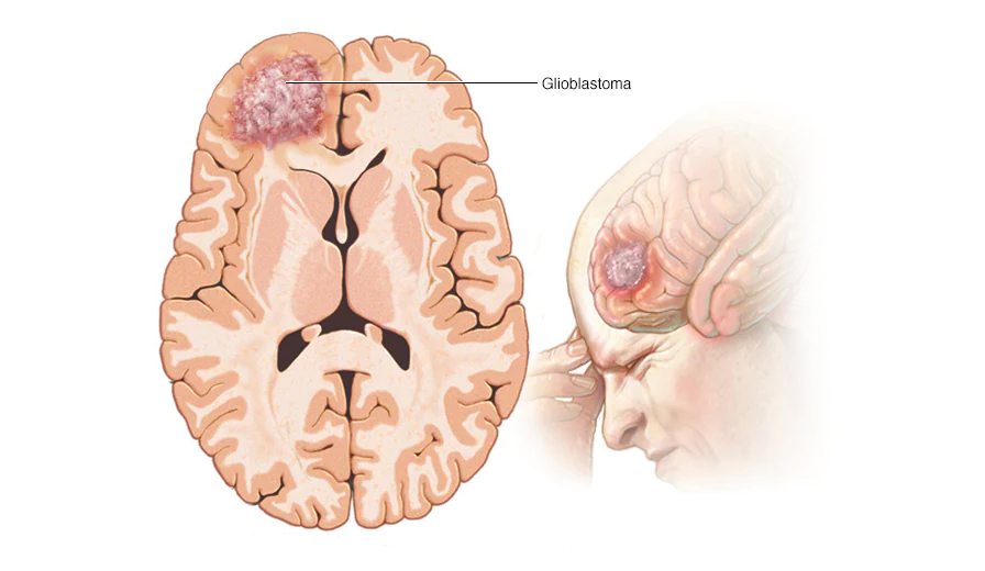 Brain cancer treatment in Malaysia