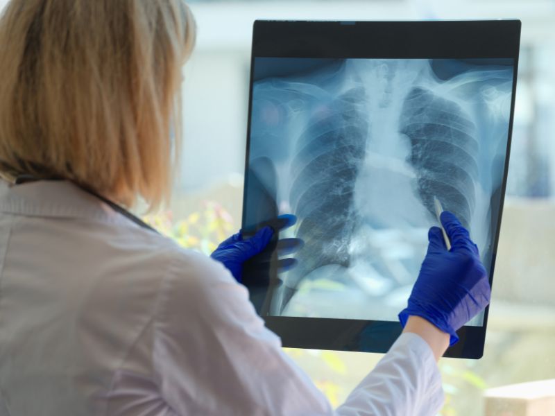 Understanding the Different Types of Lung Cancer: NSCLC vs. SCLC