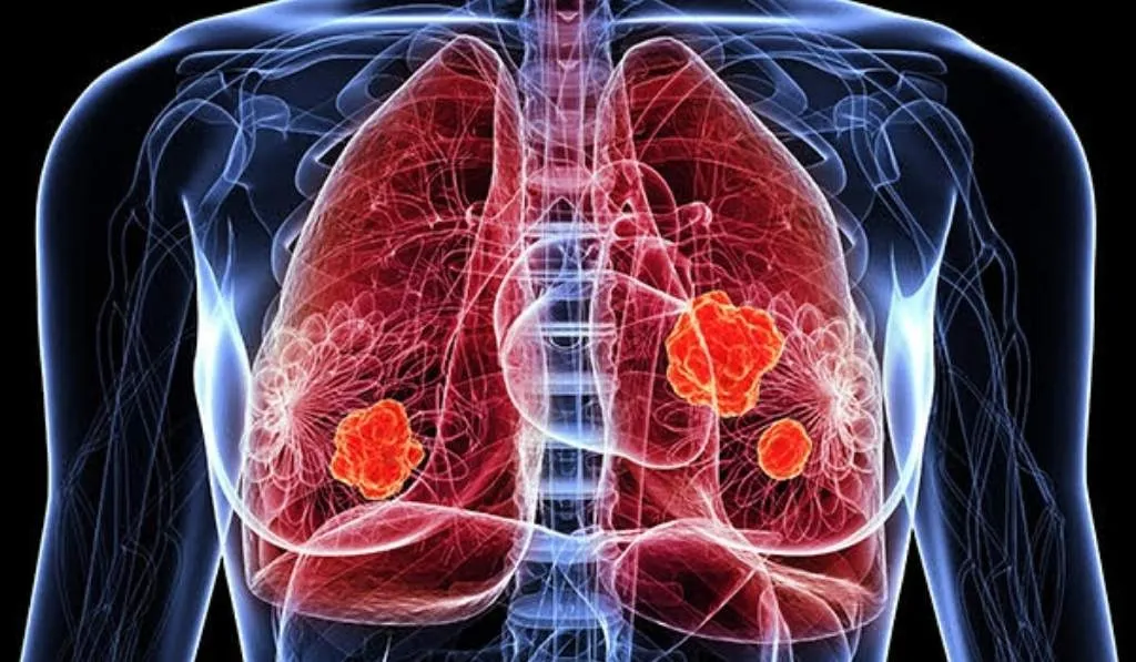 Oral HER2 lung cancer treatment with zongertinib